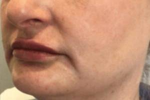 Face after dermal filler treatment, three-quarter view — Dr. Rudderman, Atlanta.