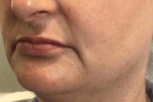 Face before dermal filler treatment, three-quarter view — Dr. Rudderman, Atlanta.