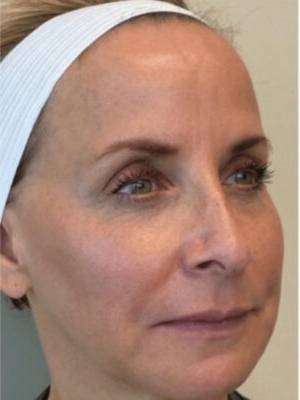 Dermal filler treatment patient photo, three-quarter view of the face — Dr. Rudderman, Atlanta.