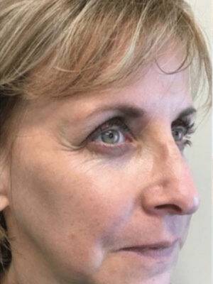 Dermal filler treatment patient photo, three-quarter view of the face — Dr. Rudderman, Atlanta.