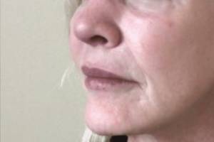 Face after dermal filler treatment, three-quarter view — Dr. Rudderman, Atlanta.