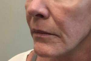 Face before dermal filler treatment, three-quarter view — Dr. Rudderman, Atlanta.