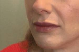 Face after dermal filler treatment, three-quarter view — Dr. Rudderman, Atlanta.