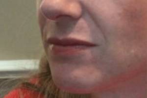 Face before dermal filler treatment, three-quarter view — Dr. Rudderman, Atlanta.
