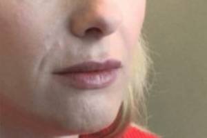 Face after dermal filler treatment, three-quarter view — Dr. Rudderman, Atlanta.