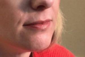 Face before dermal filler treatment, three-quarter view — Dr. Rudderman, Atlanta.