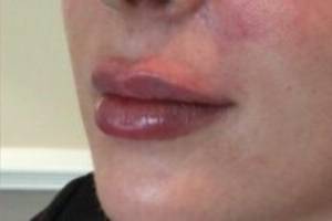 Face after dermal filler treatment, three-quarter view — Dr. Rudderman, Atlanta.