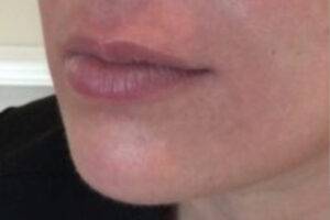 Face before dermal filler treatment, three-quarter view — Dr. Rudderman, Atlanta.