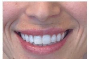 Dermal filler treatment patient photo, front view of the face — Dr. Rudderman, Atlanta.
