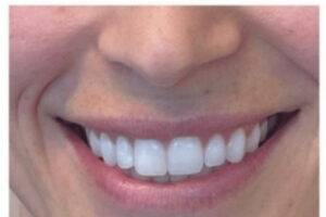 Dermal filler treatment patient photo, front view of the face — Dr. Rudderman, Atlanta.