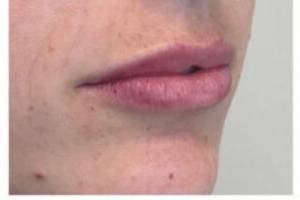 Face after dermal filler treatment, three-quarter view — Dr. Rudderman, Atlanta.