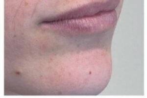 Face before dermal filler treatment, three-quarter view — Dr. Rudderman, Atlanta.