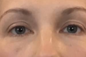 Face after dermal filler treatment, front view — Dr. Rudderman, Atlanta.