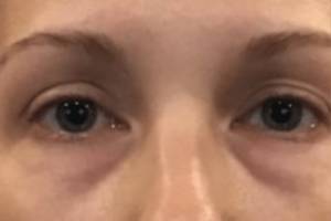Face before dermal filler treatment, front view — Dr. Rudderman, Atlanta.