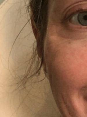 Dermal filler treatment patient photo, three-quarter view of the face — Dr. Rudderman, Atlanta.