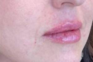 Face after dermal filler treatment, three-quarter view — Dr. Rudderman, Atlanta.