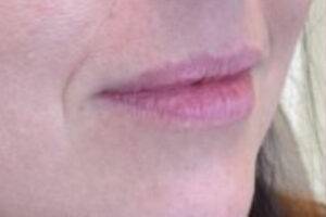 Face before dermal filler treatment, three-quarter view — Dr. Rudderman, Atlanta.
