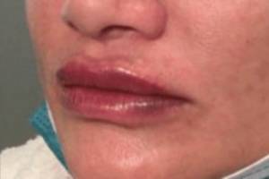 Face after dermal filler treatment, three-quarter view — Dr. Rudderman, Atlanta.