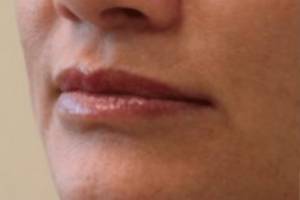 Face before dermal filler treatment, three-quarter view — Dr. Rudderman, Atlanta.