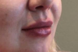 Face after dermal filler treatment, three-quarter view — Dr. Rudderman, Atlanta.