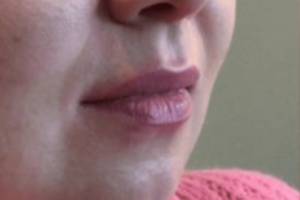 Face before dermal filler treatment, three-quarter view — Dr. Rudderman, Atlanta.