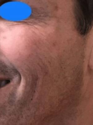 Face after dermal filler treatment, three-quarter view — Dr. Rudderman, Atlanta.