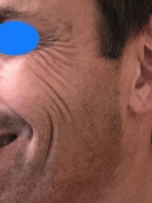 Face before dermal filler treatment, three-quarter view — Dr. Rudderman, Atlanta.