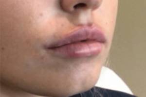 Face after dermal filler treatment, three-quarter view — Dr. Rudderman, Atlanta.