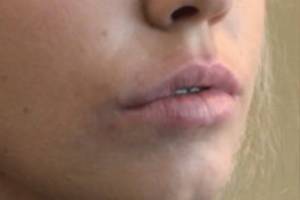Face before dermal filler treatment, three-quarter view — Dr. Rudderman, Atlanta.