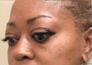 Dermal filler treatment patient photo, three-quarter view of the face — Dr. Rudderman, Atlanta.