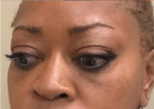 Dermal filler treatment patient photo, front view of the face — Dr. Rudderman, Atlanta.
