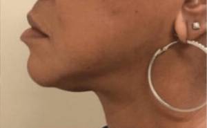 Dermal filler treatment patient photo, side profile view of the face — Dr. Rudderman, Atlanta.