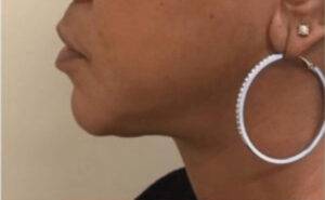 Dermal filler treatment patient photo, side profile view of the face — Dr. Rudderman, Atlanta.