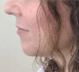 Face after dermal filler treatment, side profile view — Dr. Rudderman, Atlanta.