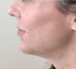 Face before dermal filler treatment, side profile view — Dr. Rudderman, Atlanta.