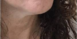 Dermal filler treatment patient photo, three-quarter view of the face — Dr. Rudderman, Atlanta.