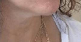 Dermal filler treatment patient photo, three-quarter view of the face — Dr. Rudderman, Atlanta.