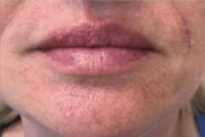 Face after dermal filler treatment, front view — Dr. Rudderman, Atlanta.