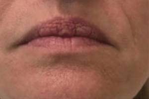 Face before dermal filler treatment, front view — Dr. Rudderman, Atlanta.
