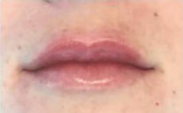 Face after dermal filler treatment, front view — Dr. Rudderman, Atlanta.