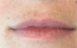 Face before dermal filler treatment, front view — Dr. Rudderman, Atlanta.