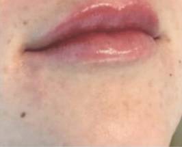 Face after dermal filler treatment, front view — Dr. Rudderman, Atlanta.