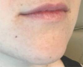 Face before dermal filler treatment, front view — Dr. Rudderman, Atlanta.