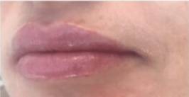 Face after dermal filler treatment, three-quarter view — Dr. Rudderman, Atlanta.