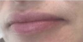 Face before dermal filler treatment, three-quarter view — Dr. Rudderman, Atlanta.