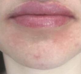 Face after dermal filler treatment, front view — Dr. Rudderman, Atlanta.