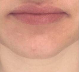 Face before dermal filler treatment, front view — Dr. Rudderman, Atlanta.