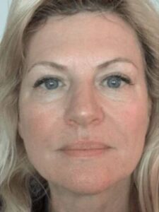 Face after dermal filler treatment, front view — Dr. Rudderman, Atlanta.