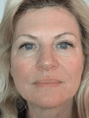 Face after dermal filler treatment, front view — Dr. Rudderman, Atlanta.