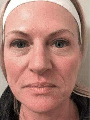 Face before dermal filler treatment, front view — Dr. Rudderman, Atlanta.